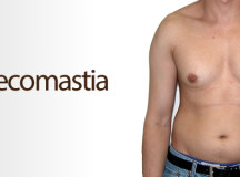 Enlarged Breasts in Males